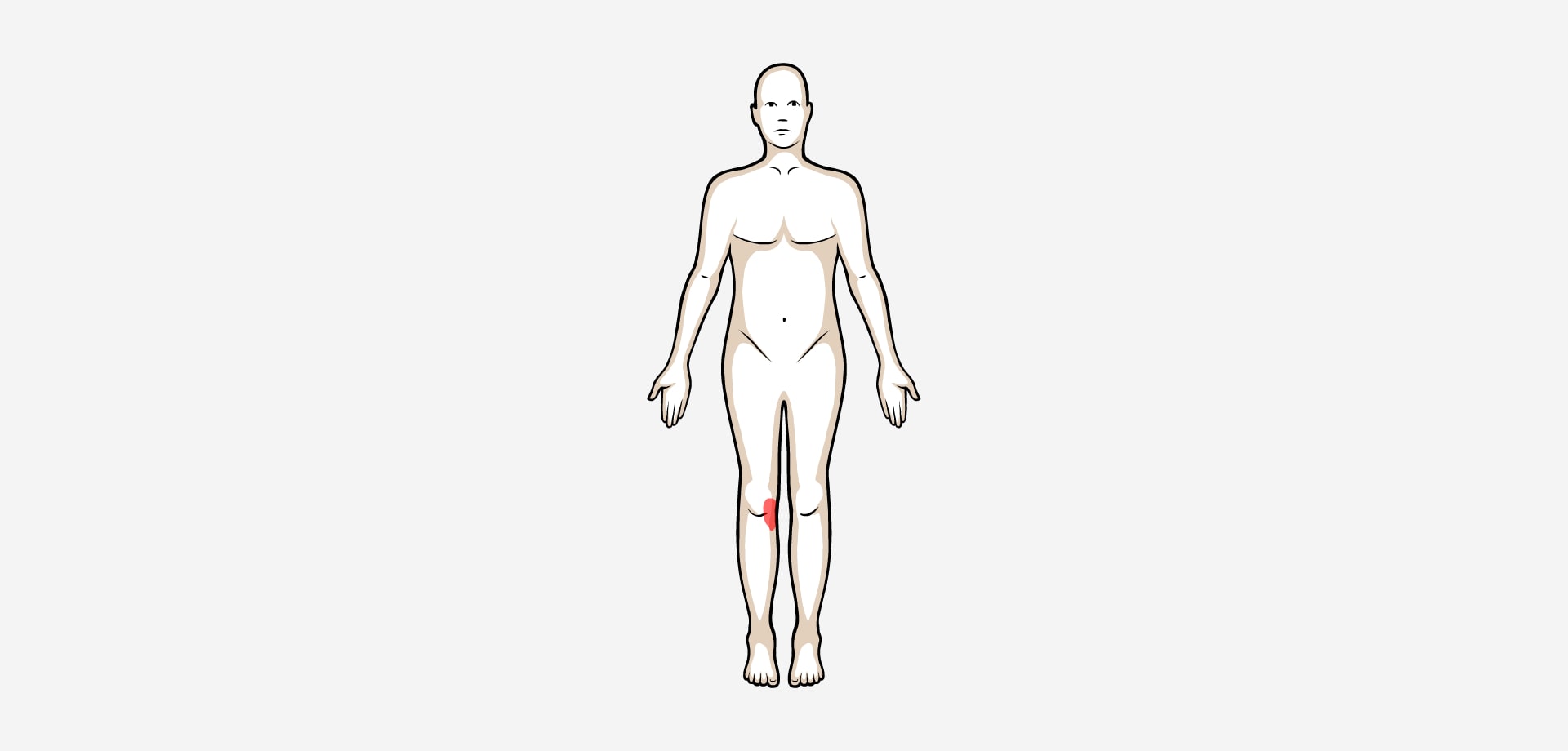 Dolor medial rodilla
